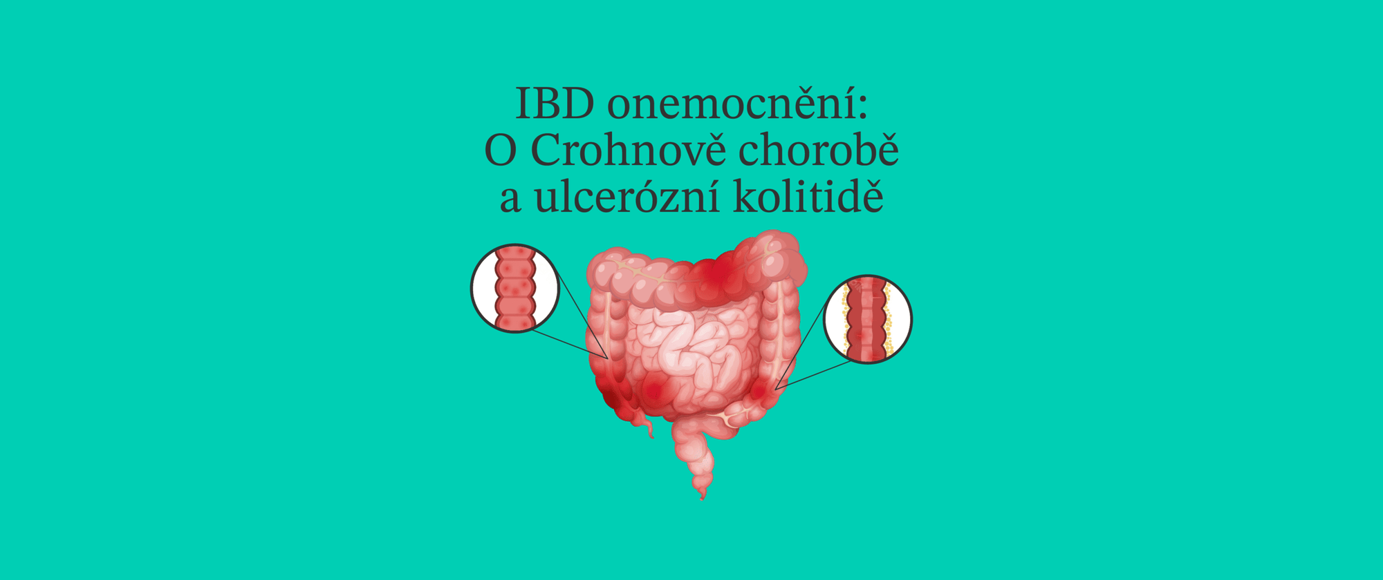 Gastroenterológ o IBD ochoreniach: Crohnova choroba a ulcerózna kolitída